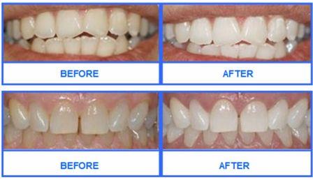 whitewash teeth whitening before and after